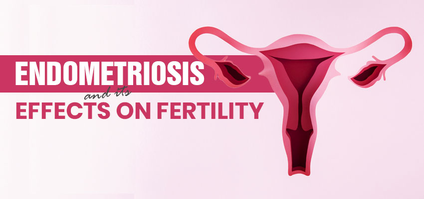 Endometriosis and its Effects on Fertility