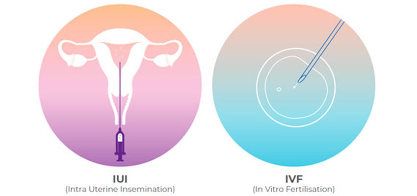 IUI vs IVF: Which is right for you?